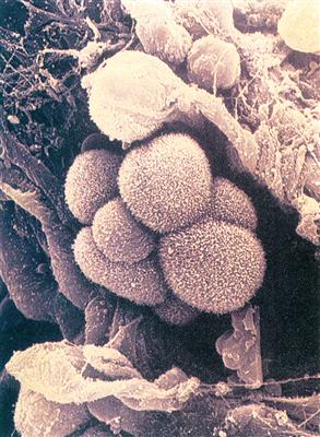 电镜下的肺癌细胞
